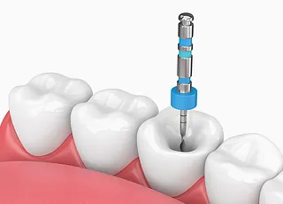 Endodoncia