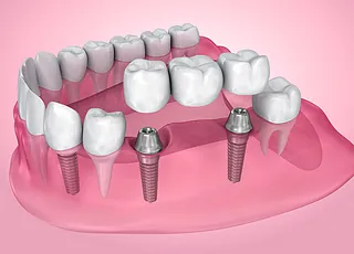 PRÓTESIS SOBRE IMPLANTES ESPECIALISTAS 