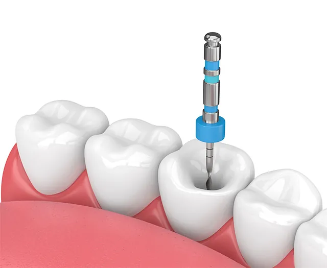 endodoncia